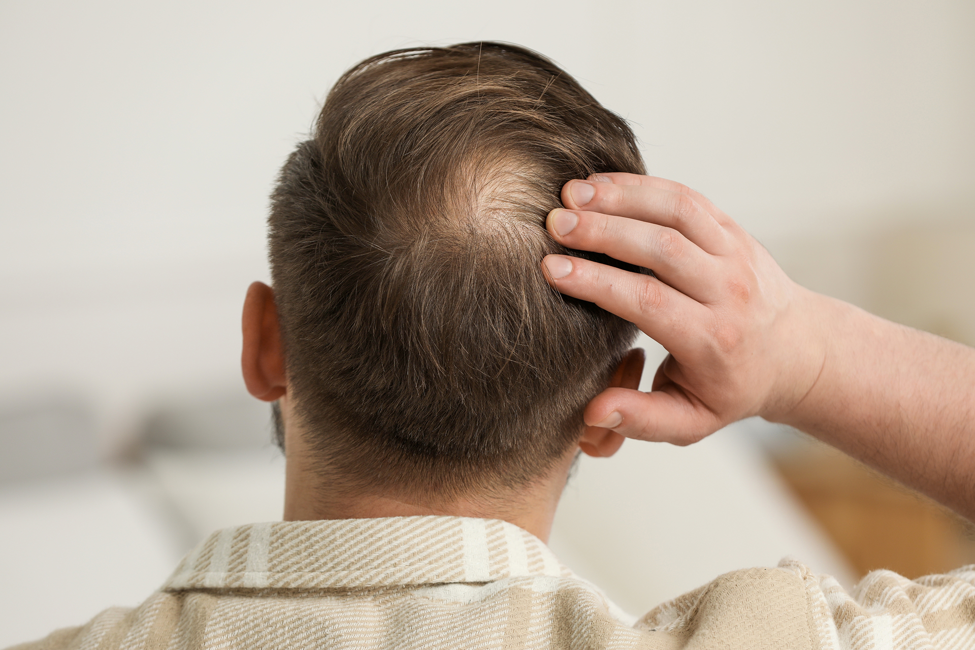 cliniqueverdun calvitie homme