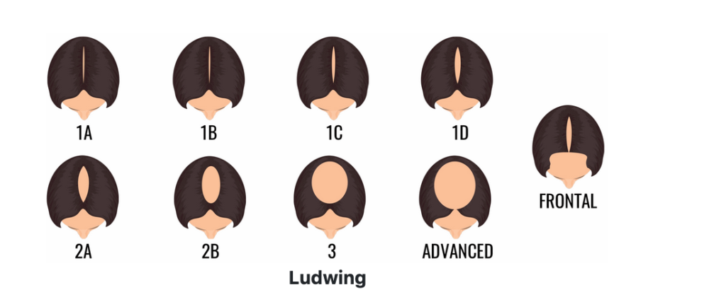 cliniqueverdun chute cheveux femme