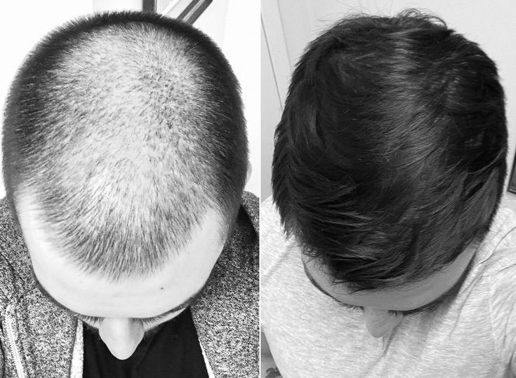 cliniqueverdun greffe cheveux avant apres