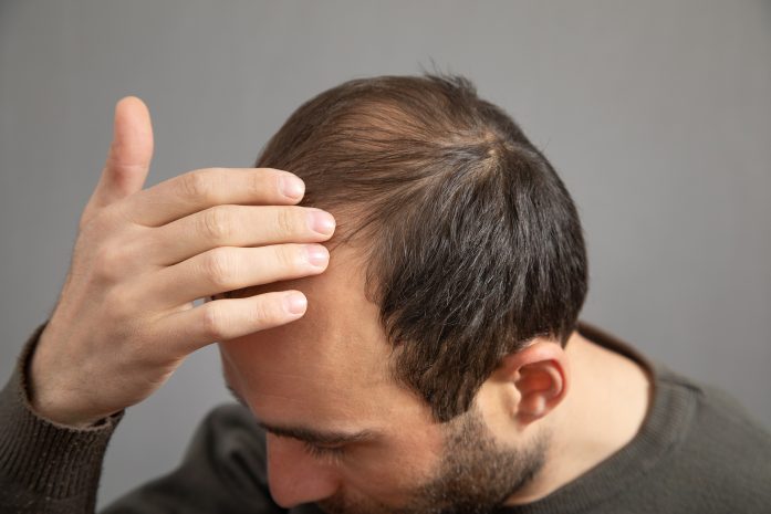 Implant capillaire à Nice et Cannes - Clinique Le Verdun