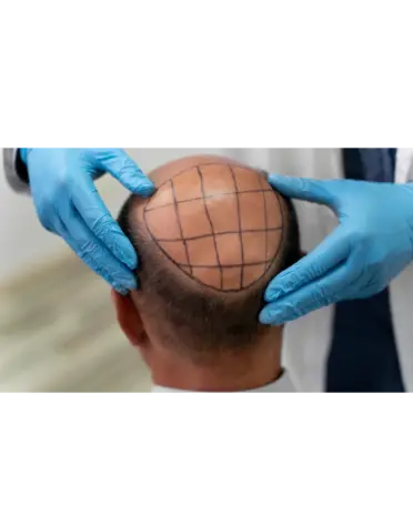 Greffe de cheveux à la rentrée pour retrouver une densité capillaire naturelle