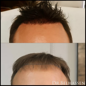 ligne frontale naturelle greffe cheveux naturel resultat docteur belhassen